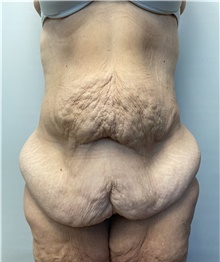Panniculectomy Before Photo by Owen Reid, MD; Vancouver, BC - Case 47952