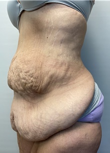 Panniculectomy Before Photo by Owen Reid, MD; Vancouver, BC - Case 47952