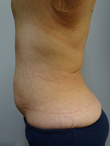 Panniculectomy After Photo by Owen Reid, MD; Vancouver, BC - Case 47952