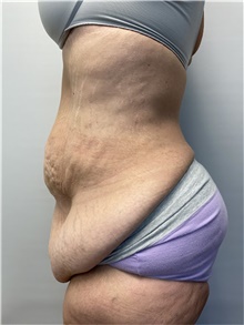 Panniculectomy Before Photo by Owen Reid, MD; Richmond, BC - Case 47952