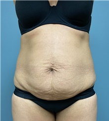 Tummy Tuck Before Photo by Owen Reid, MD; Vancouver, BC - Case 47953