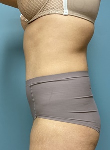 Tummy Tuck After Photo by Owen Reid, MD; Vancouver, BC - Case 47953