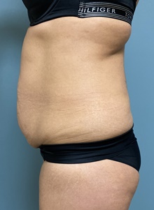 Tummy Tuck Before Photo by Owen Reid, MD; Richmond, BC - Case 47953