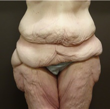 Body Contouring Before Photo by Owen Reid, MD; Vancouver, BC - Case 47962