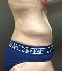 Body Contouring After Photo by Owen Reid, MD; Vancouver, BC - Case 47962