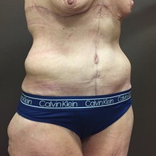Body Contouring After Photo by Owen Reid, MD; Vancouver, BC - Case 47962