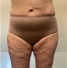 Body Contouring After Photo by Owen Reid, MD; Richmond, BC - Case 47972