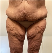 Body Contouring Before Photo by Owen Reid, MD; Vancouver, BC - Case 47972