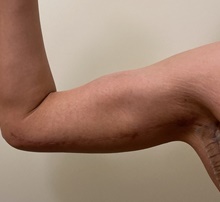 Arm Lift After Photo by Owen Reid, MD; Vancouver, BC - Case 47973