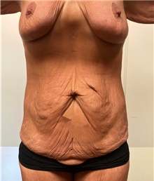 Body Contouring Before Photo by Owen Reid, MD; Vancouver, BC - Case 47976