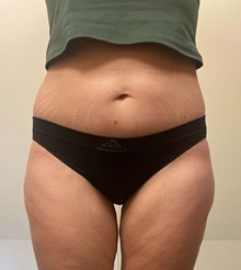 Body Contouring After Photo by Owen Reid, MD; Richmond, BC - Case 47977