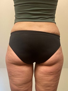 Body Contouring After Photo by Owen Reid, MD; Vancouver, BC - Case 47977