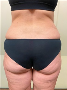 Body Contouring Before Photo by Owen Reid, MD; Vancouver, BC - Case 47977