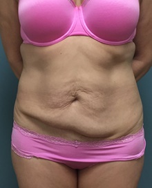 Tummy Tuck Before Photo by Owen Reid, MD; Richmond, BC - Case 47992