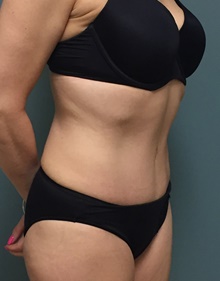 Tummy Tuck After Photo by Owen Reid, MD; Vancouver, BC - Case 47992