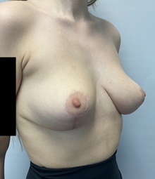 Breast Lift After Photo by Owen Reid, MD; Vancouver, BC - Case 48164