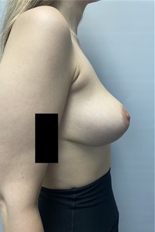 Breast Lift After Photo by Owen Reid, MD; Richmond, BC - Case 48164