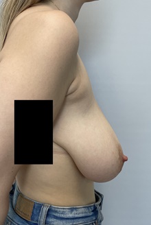 Breast Lift Before Photo by Owen Reid, MD; Vancouver, BC - Case 48164