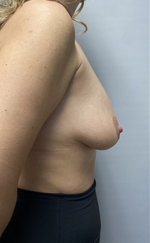 Breast Lift Before Photo by Owen Reid, MD; Vancouver, BC - Case 48200