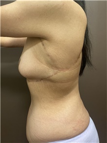 Body Contouring After Photo by Owen Reid, MD; Vancouver, BC - Case 48201