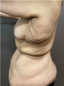 Body Contouring Before Photo by Owen Reid, MD; Vancouver, BC - Case 48201