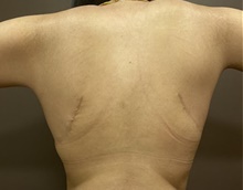 Body Contouring After Photo by Owen Reid, MD; Vancouver, BC - Case 48201