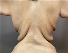 Body Contouring Before Photo by Owen Reid, MD; Richmond, BC - Case 48201