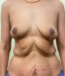 Body Contouring After Photo by Owen Reid, MD; Richmond, BC - Case 48201