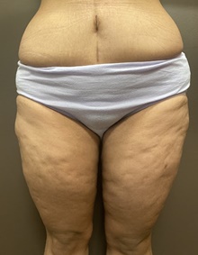 Thigh Lift After Photo by Owen Reid, MD; Vancouver, BC - Case 48203
