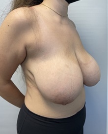 Breast Reduction Before Photo by Owen Reid, MD; Richmond, BC - Case 48241