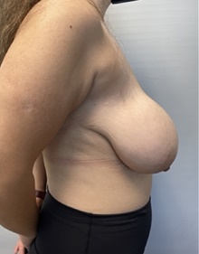 Breast Reduction Before Photo by Owen Reid, MD; Richmond, BC - Case 48241