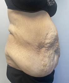 Body Contouring Before Photo by Owen Reid, MD; Vancouver, BC - Case 48242
