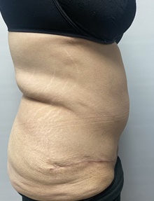 Body Contouring After Photo by Owen Reid, MD; Vancouver, BC - Case 48242