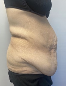 Body Contouring Before Photo by Owen Reid, MD; Richmond, BC - Case 48242