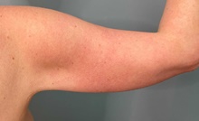 Arm Lift After Photo by Owen Reid, MD; Richmond, BC - Case 48245