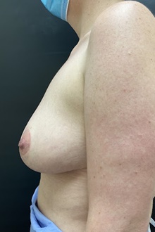 Breast Lift After Photo by Owen Reid, MD; Richmond, BC - Case 48248