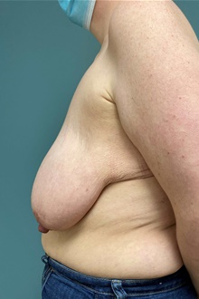 Breast Lift Before Photo by Owen Reid, MD; Vancouver, BC - Case 48248