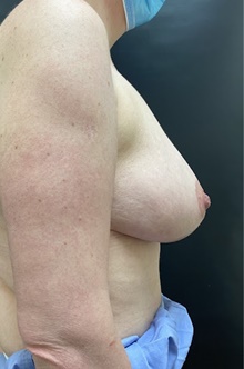 Breast Lift After Photo by Owen Reid, MD; Vancouver, BC - Case 48248