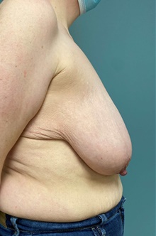 Breast Lift Before Photo by Owen Reid, MD; Vancouver, BC - Case 48248