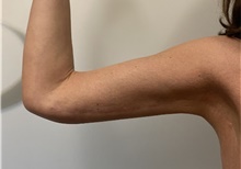 Arm Lift After Photo by Owen Reid, MD; Vancouver, BC - Case 48367