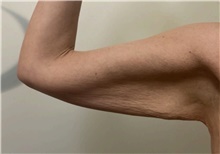 Arm Lift Before Photo by Owen Reid, MD; Richmond, BC - Case 48367