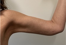 Arm Lift After Photo by Owen Reid, MD; Richmond, BC - Case 48367