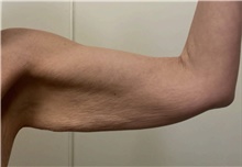 Arm Lift Before Photo by Owen Reid, MD; Vancouver, BC - Case 48367