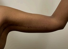 Arm Lift After Photo by Owen Reid, MD; Vancouver, BC - Case 48368