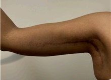 Arm Lift After Photo by Owen Reid, MD; Richmond, BC - Case 48368