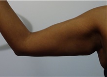 Arm Lift Before Photo by Owen Reid, MD; Richmond, BC - Case 48368