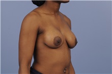 Breast Augmentation After Photo by Trent Douglas, MD; Greenbrae, CA - Case 31393
