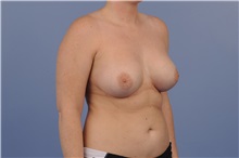Breast Augmentation After Photo by Trent Douglas, MD; Greenbrae, CA - Case 31397