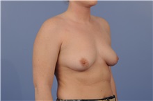 Breast Augmentation Before Photo by Trent Douglas, MD; Greenbrae, CA - Case 31397