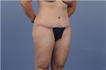 Tummy Tuck After Photo by Trent Douglas, MD; Greenbrae, CA - Case 31401